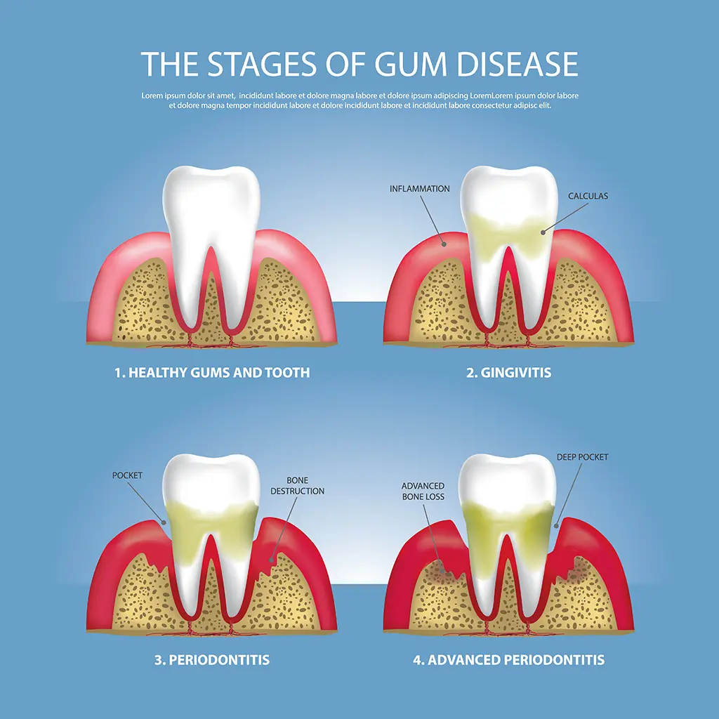 Illustration of the stages of gum disease, showcasing common gum problems and their impact on gum health, provided by Montana Center for Implants and Dentures.