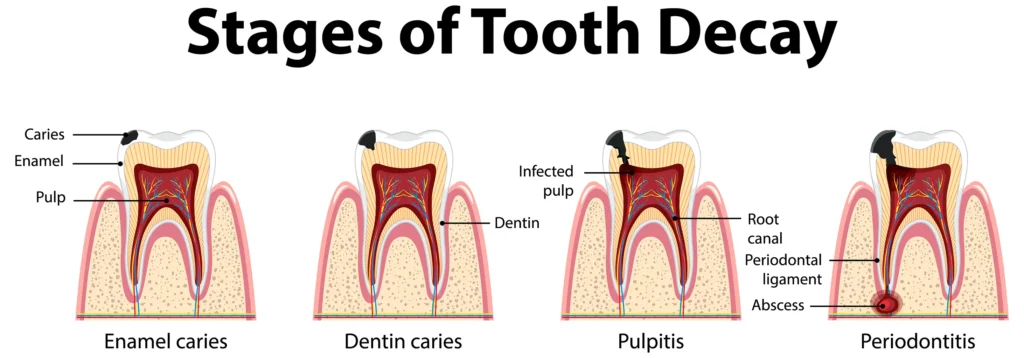 Illustration of the stages of tooth decay, showing how diabetes can impact oral health, explained by Montana Center for Implants and Dentures.