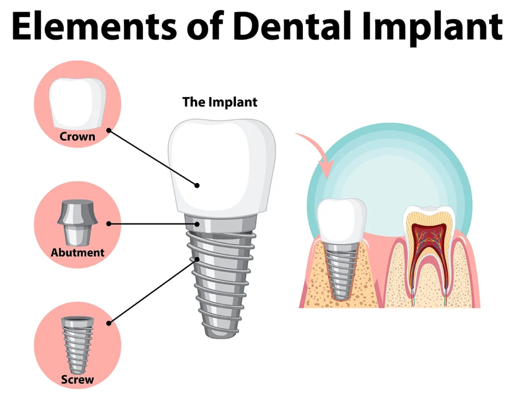 Illustration of the elements of dental implants, showing how implants are used to replace teeth lost due to gum disease, as provided by Montana Center for Implants and Dentures.