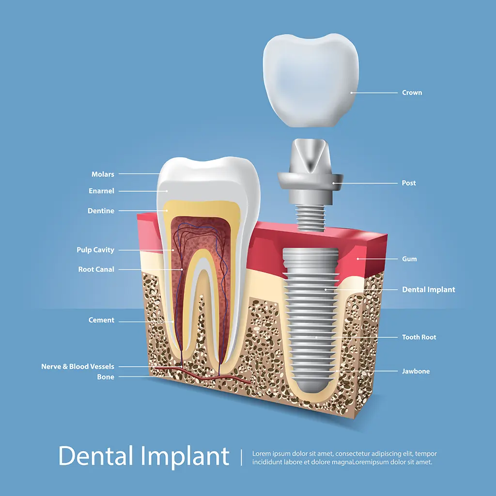 Detailed cross-section diagram of a dental implant, illustrating components such as the crown, post, and integration with the jawbone, highlighting the most affordable dental implants available at the Montana Center for Implants and Dentures.