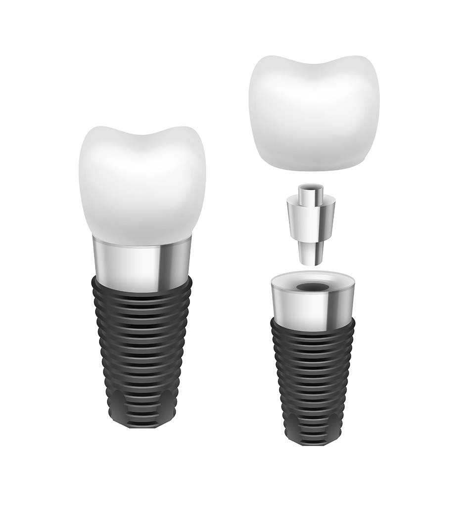 Illustration of a dental implant showing components used for permanent tooth replacement, offered at Montana Center for Implants and Dentures, with expertise in oral surgery, dentures, and implants.