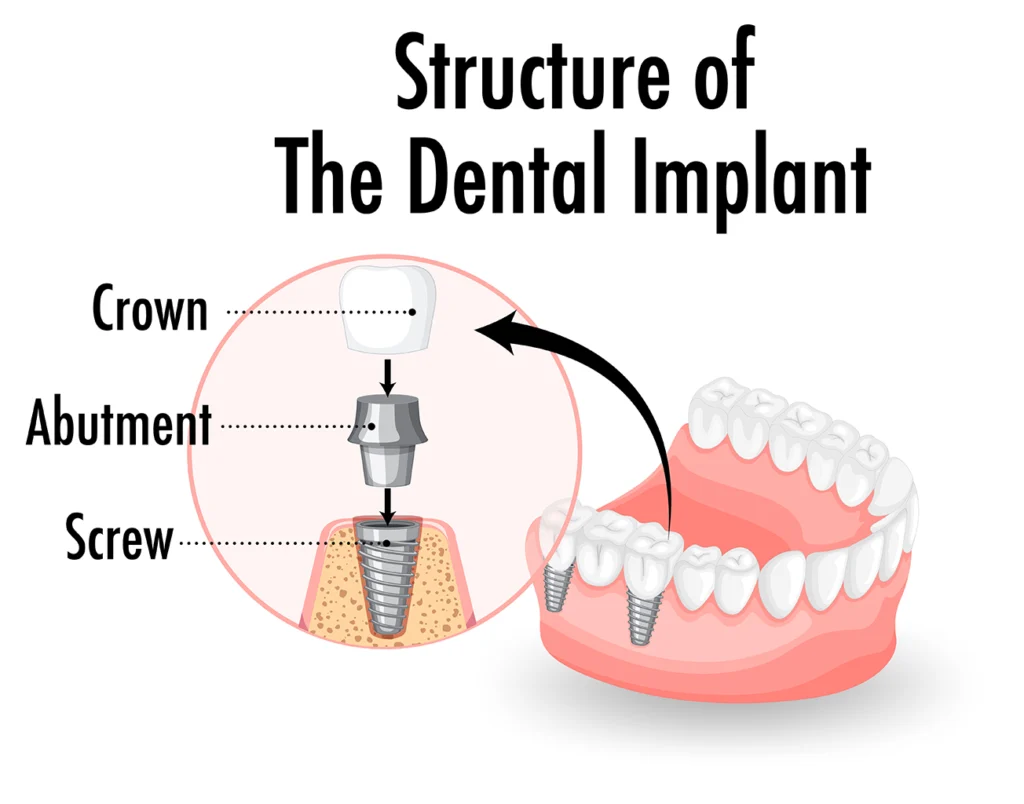 Illustration of the structure of a dental implant showing the crown, abutment, and screw, provided by Montana Center for Implants and Dentures for oral surgery in Billings, MT.